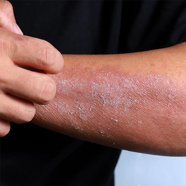 Skin irritation and allergies